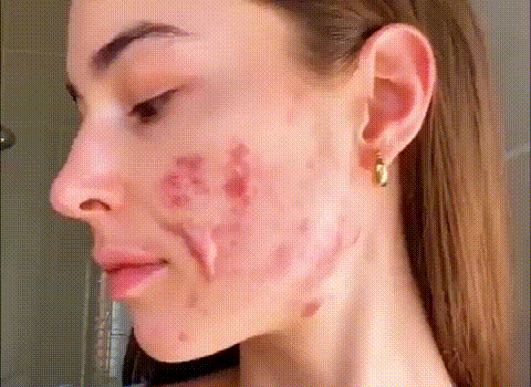 بخاخ ازالة الندبات والجروح الجديد